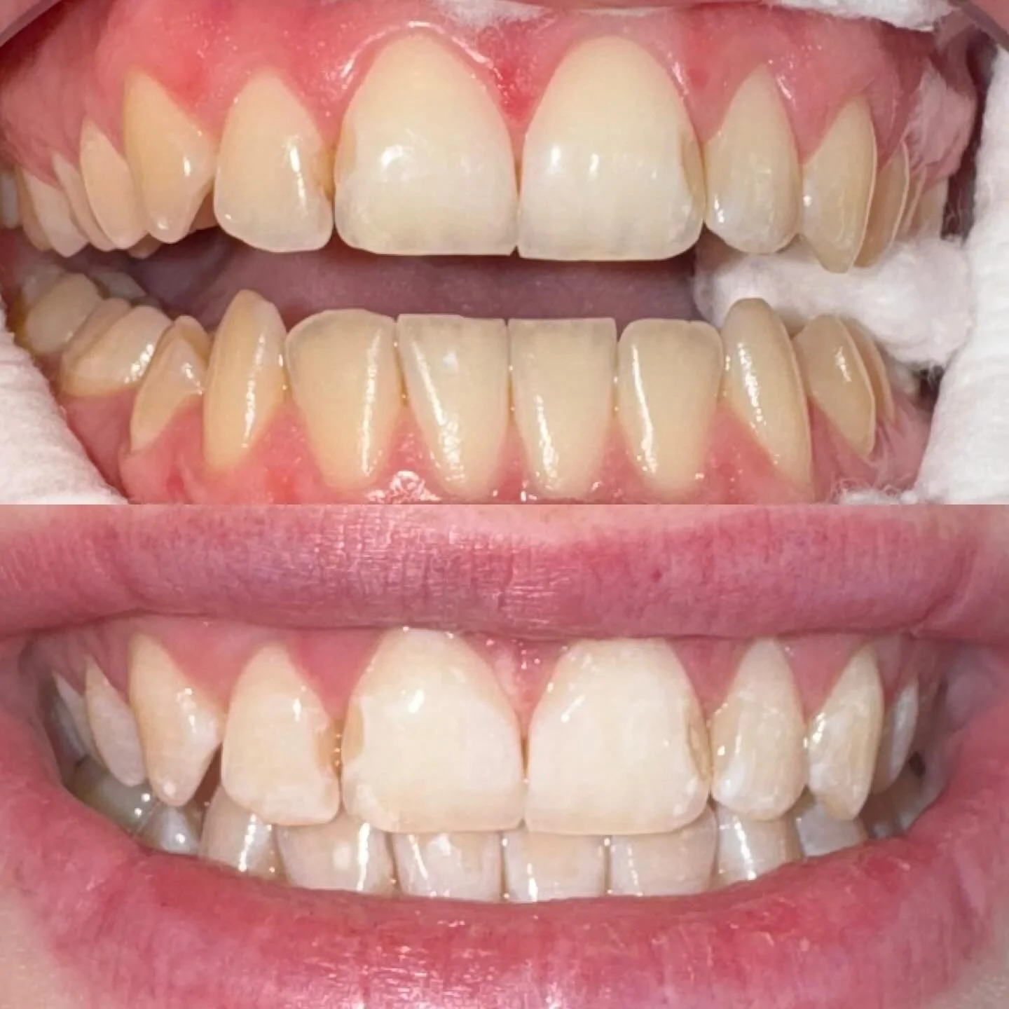 One session. Noticeably whiter teeth!!
Swipe for results!! Rachel is your girl for a brighter, whiter smile! 🦷✨