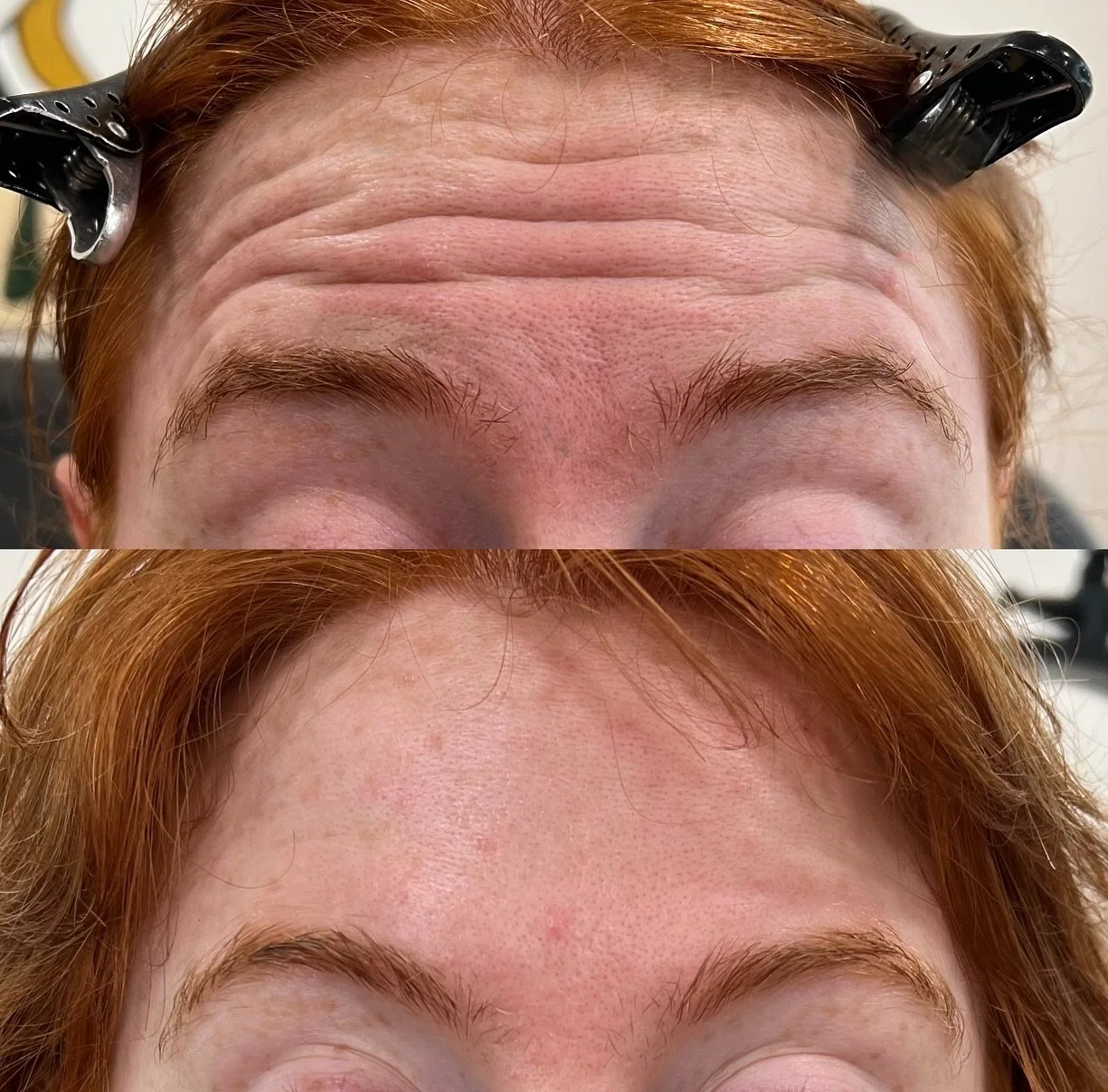 Botox isn&rsquo;t about changing your face, it&rsquo;s about refreshing it!! 💉😄