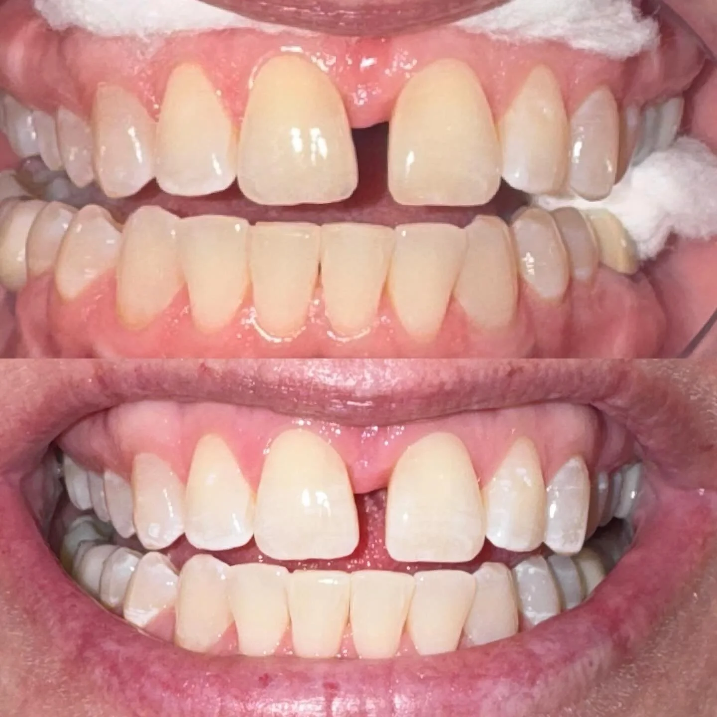 Instant glow-up results! Brighter, whiter, and full of confidence! 🦷✨