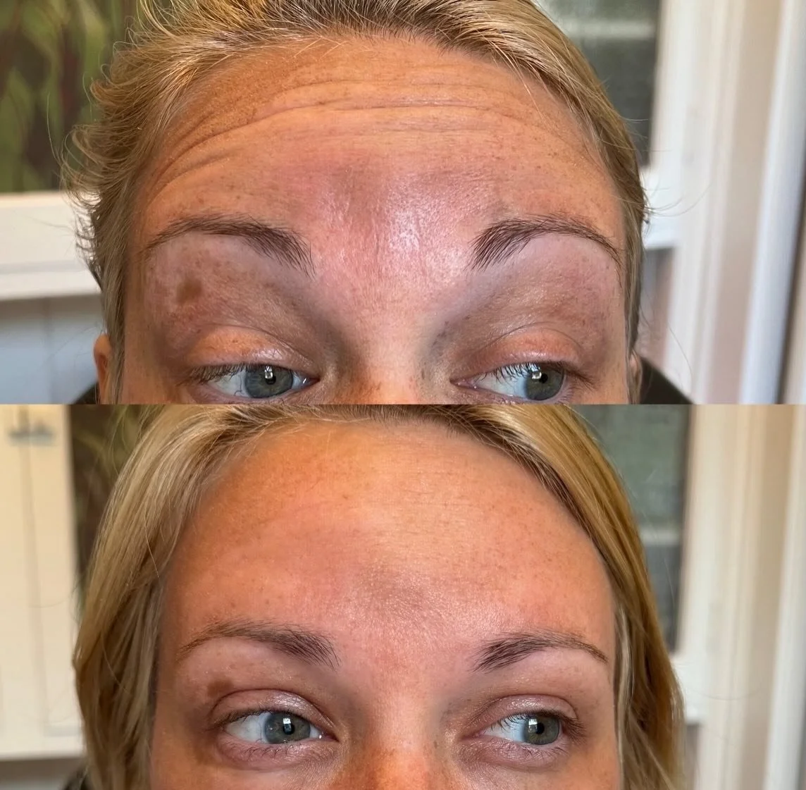 Forehead lines? Not anymore! Smooth results without the frozen look ✨💉