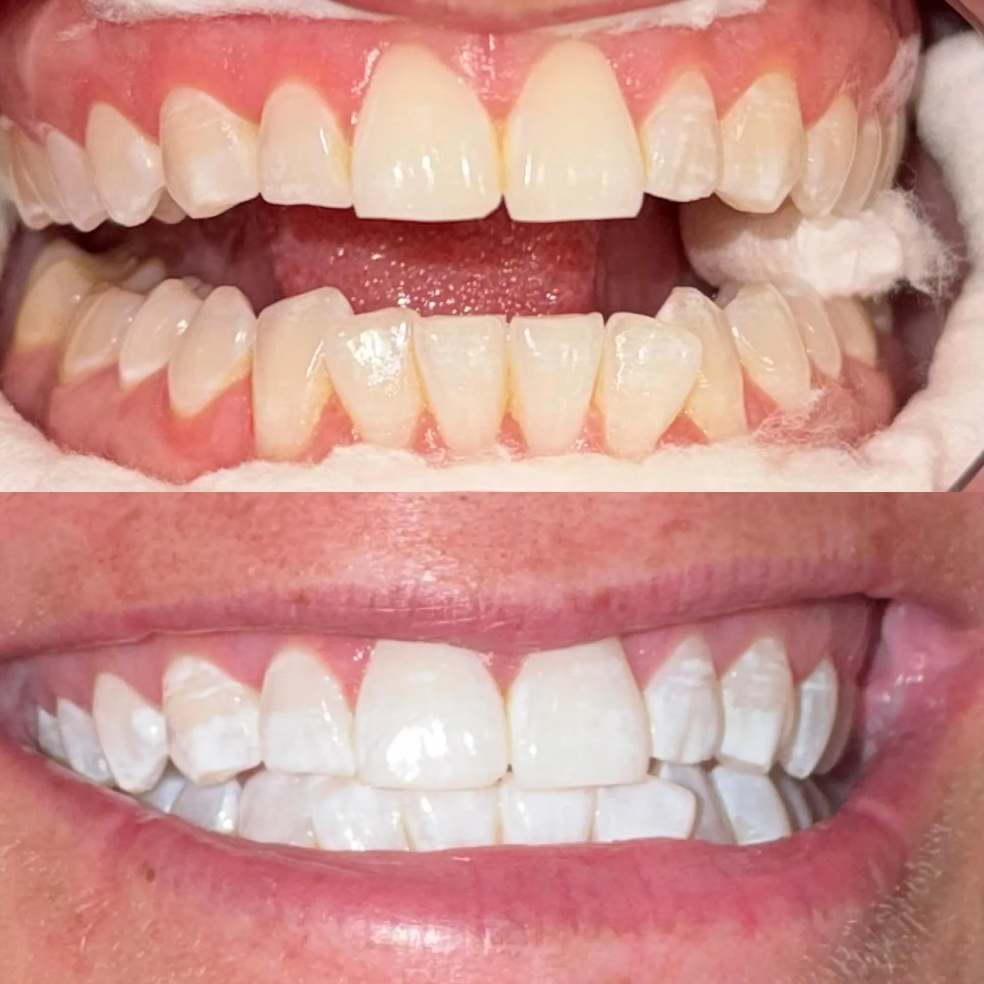 Confidence starts with a smile 😁✨ Check out these amazing teeth whitening result