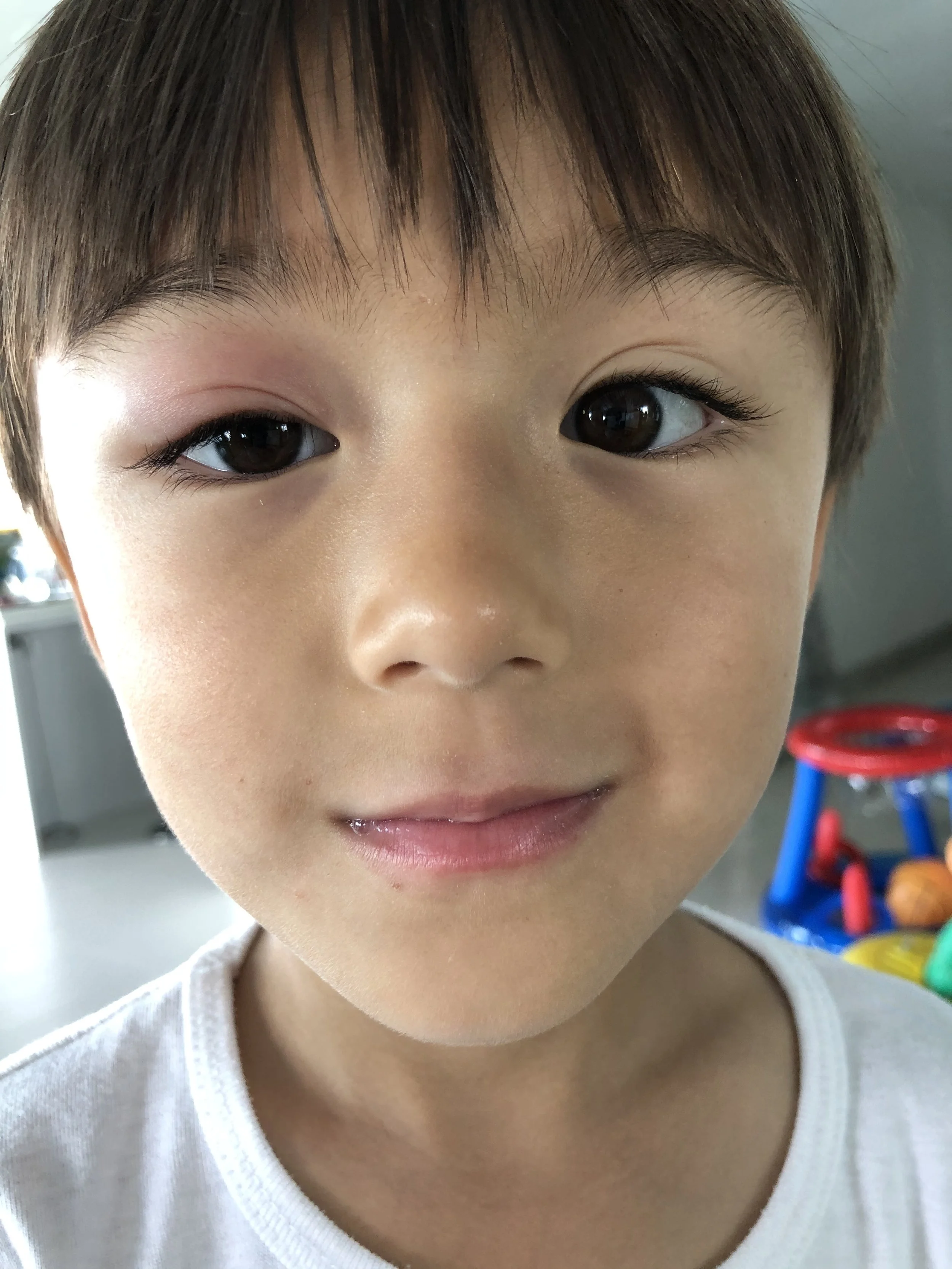 Styes and chalazions “I don’t want surgery for my son”