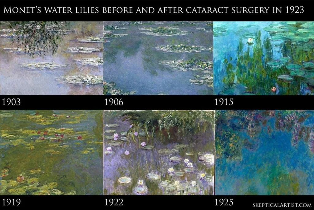 Learn how cataracts may have shaped the style of famous Impressionist painters. A unique blend of art and eye health by Dr Cheryl Lee.