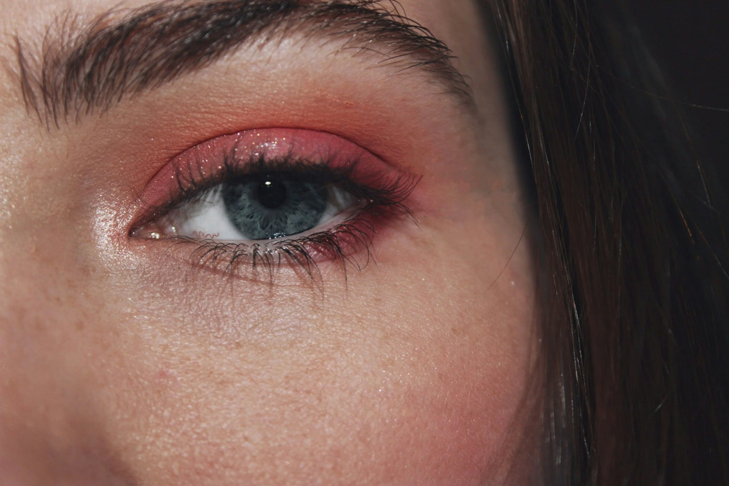 Ocular rosacea and the eyes 