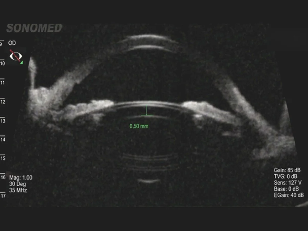 good icl size with vault of 0.5mm