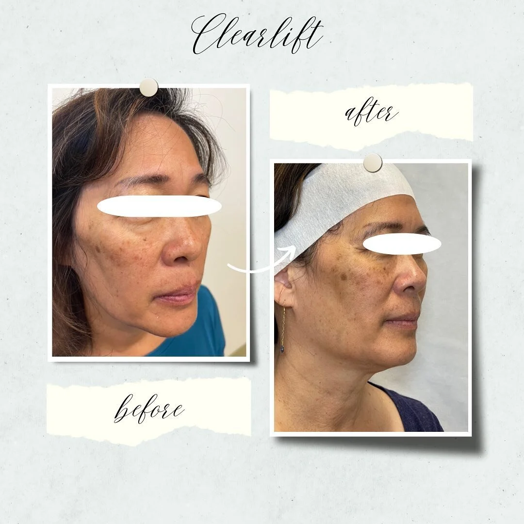Great results after only 5 Clearlift treatments with the Harmony XL laser! 

This patient came in with concerns about sun spots and wrinkles on her face. After only 5 treatments she has been blown away by the results! Call us today to book a consult 