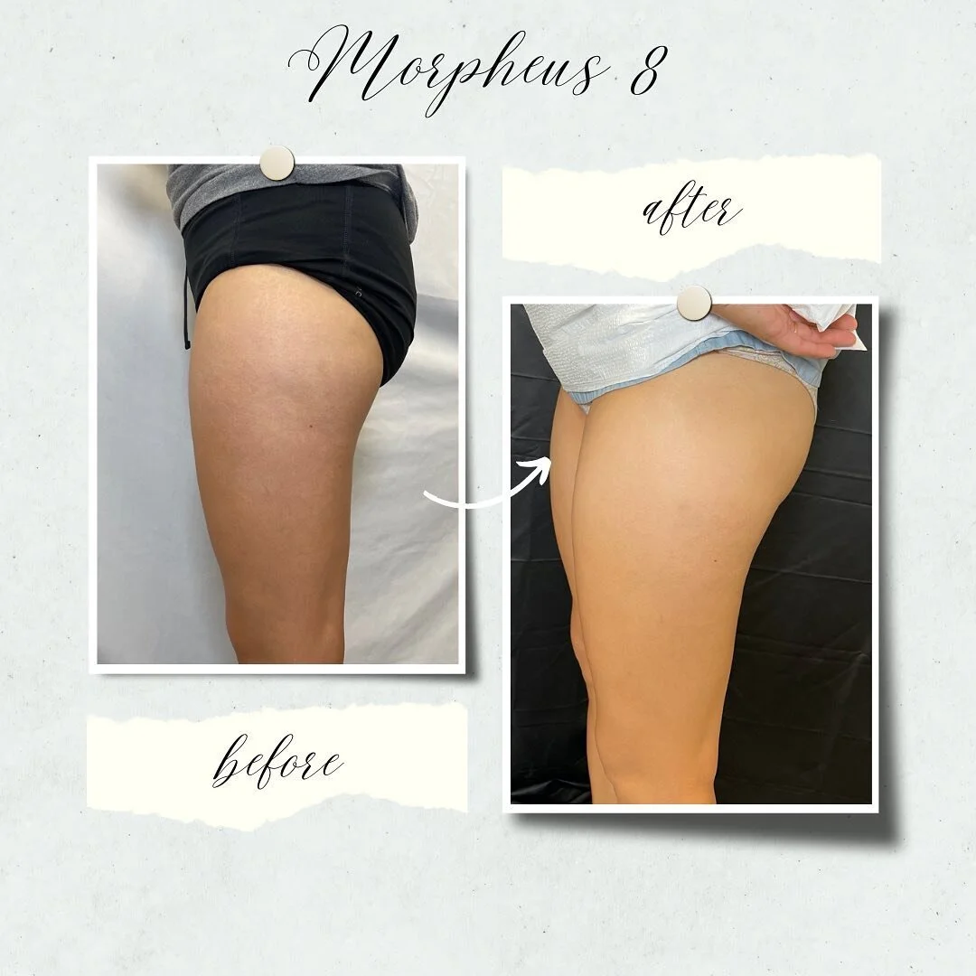 Morpheus 8 is a skin rejuvenation treatment that uses the Votiva&rsquo;s RF micro needling to smooth out and remove blemishes from skin, this extremely happy patient chose to do the treatment on her legs and buttocks area. 
Schedule your consult toda
