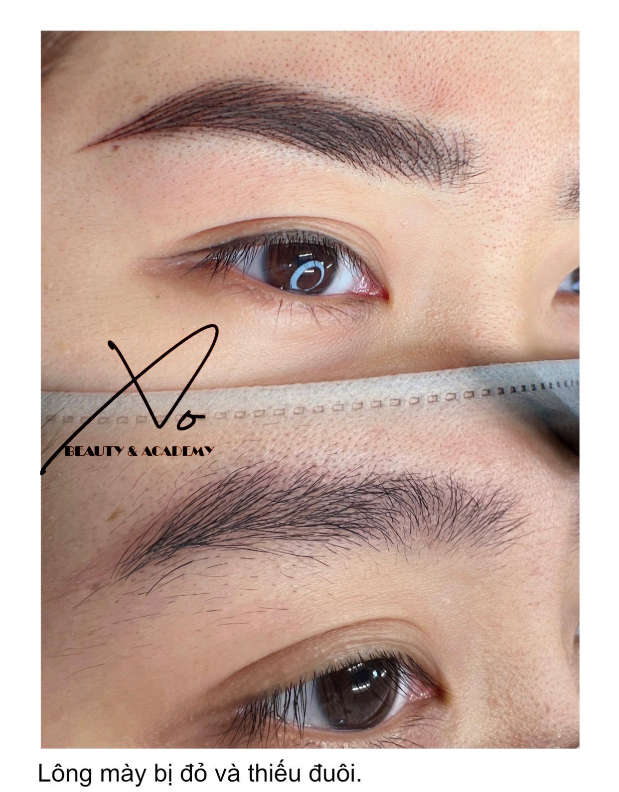 Close-up of a person's eye showing red and lack of eyebrow hair, with text in Vietnamese that translates to 'Eyebrows are red and lacking hair'.