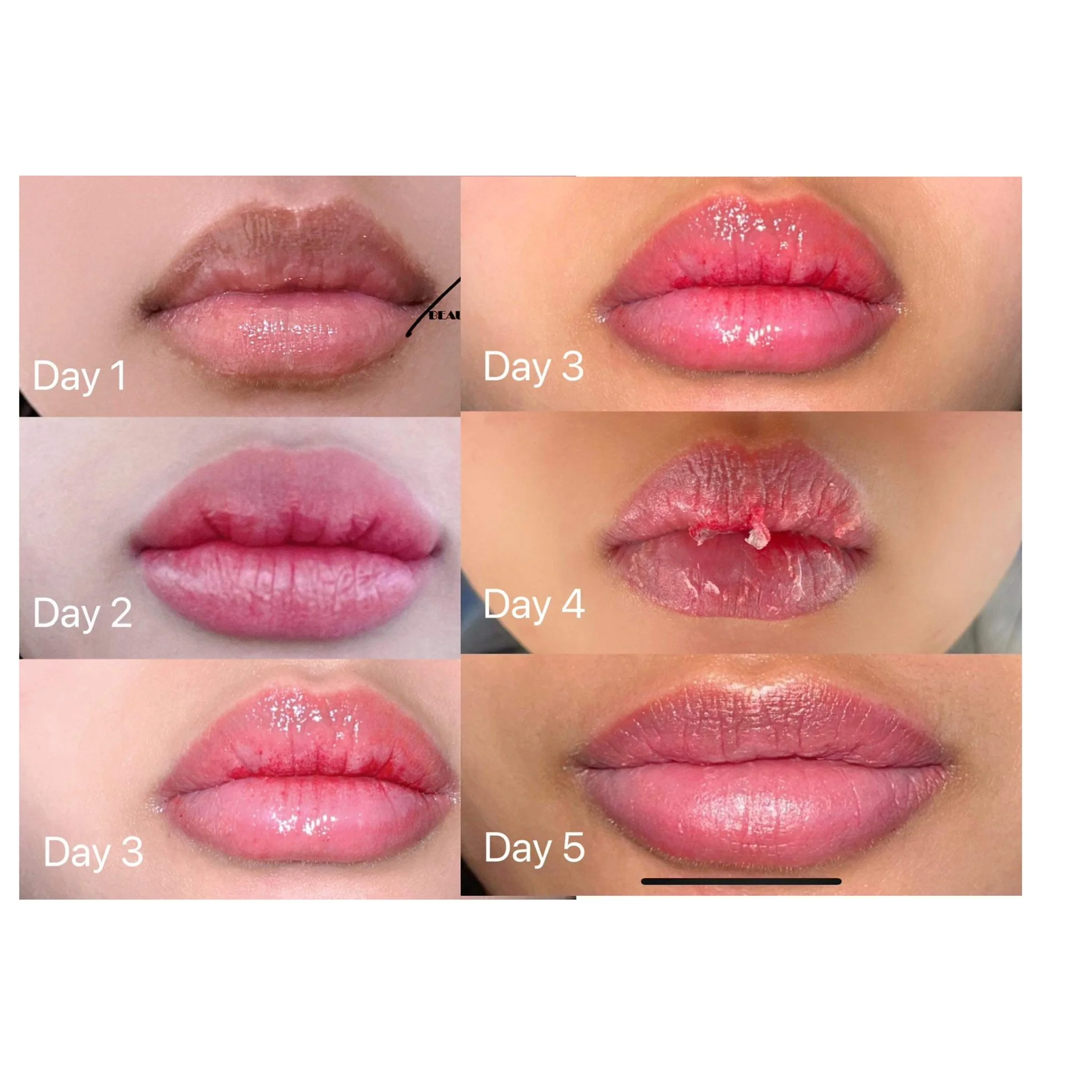 Progression of lips over five days showing healing and dryness, with labels for days 1 through 5.