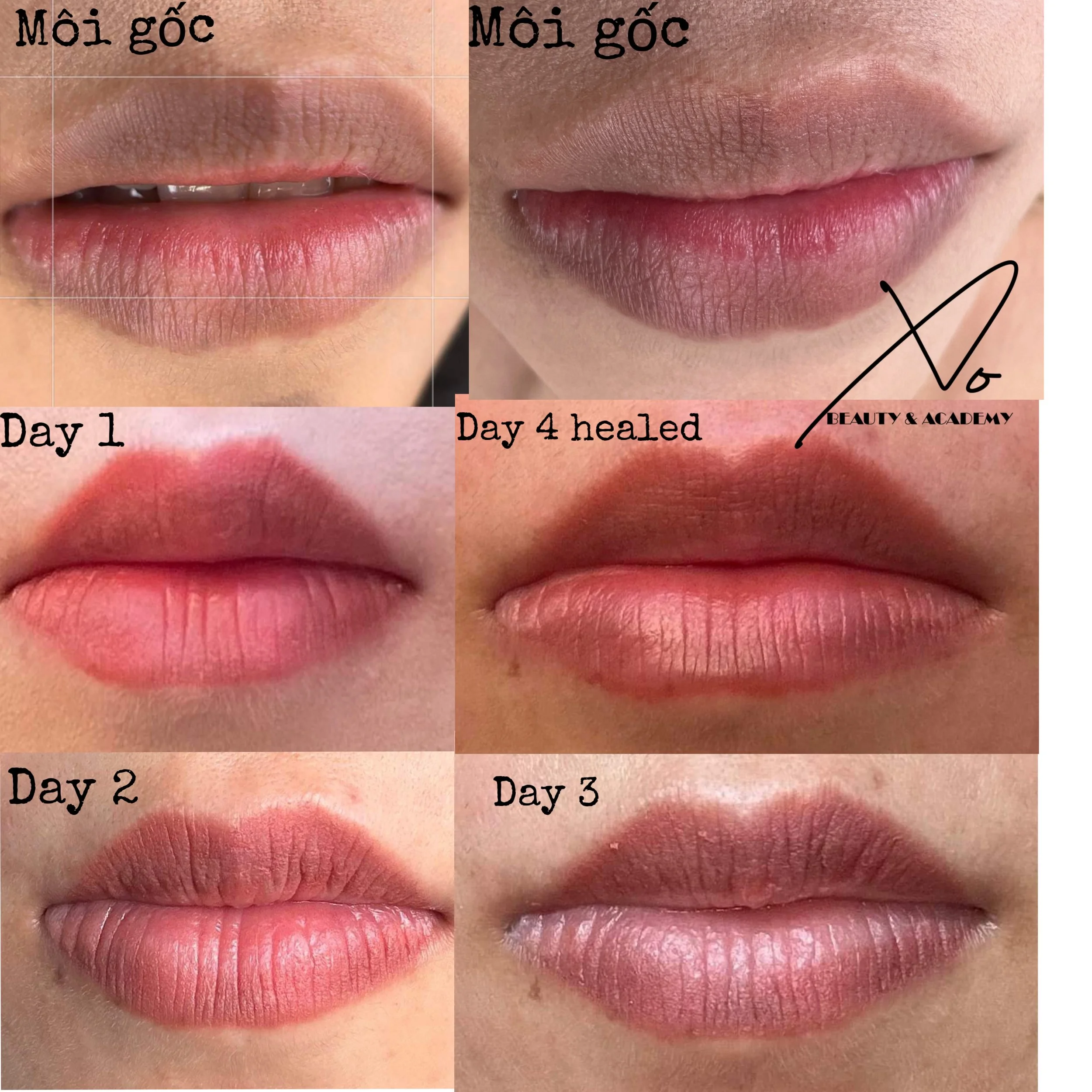 A collage showing the healing process of lips with a cold sore. Top left shows lips on day 1 with a cold sore. Top right shows lips at a healed stage. The bottom row shows the progress over several days: day 1 with a cold sore, day 2 with slight heal