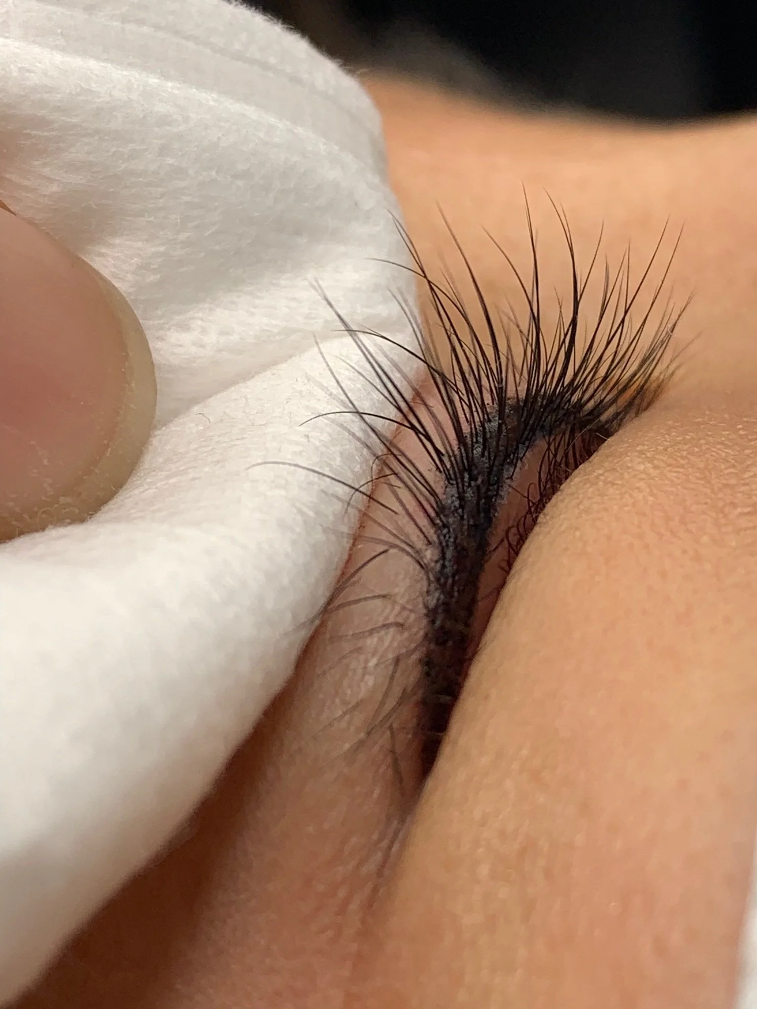 Close-up of a person's eye with long eyelashes being examined or treated by a medical professional wearing a white glove.