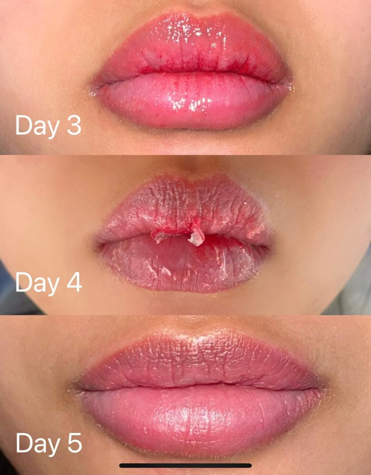 Timeline of lips from Day 3 to Day 5 shows healing process with increased moisture and reduced dryness and peeling.
