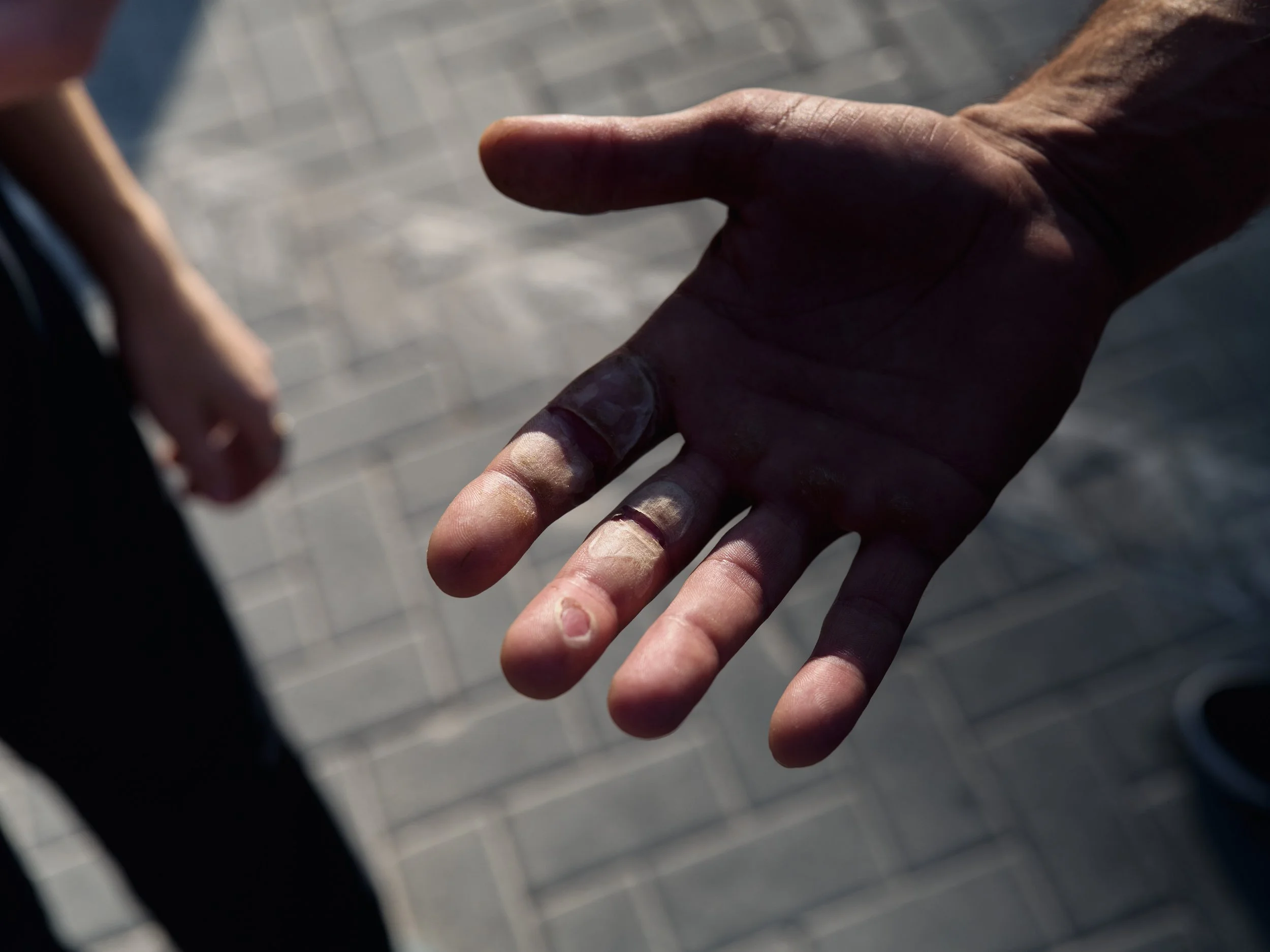 A demonstrator’s hand is burned while handling a hot tear gas canister removed from the crowd.