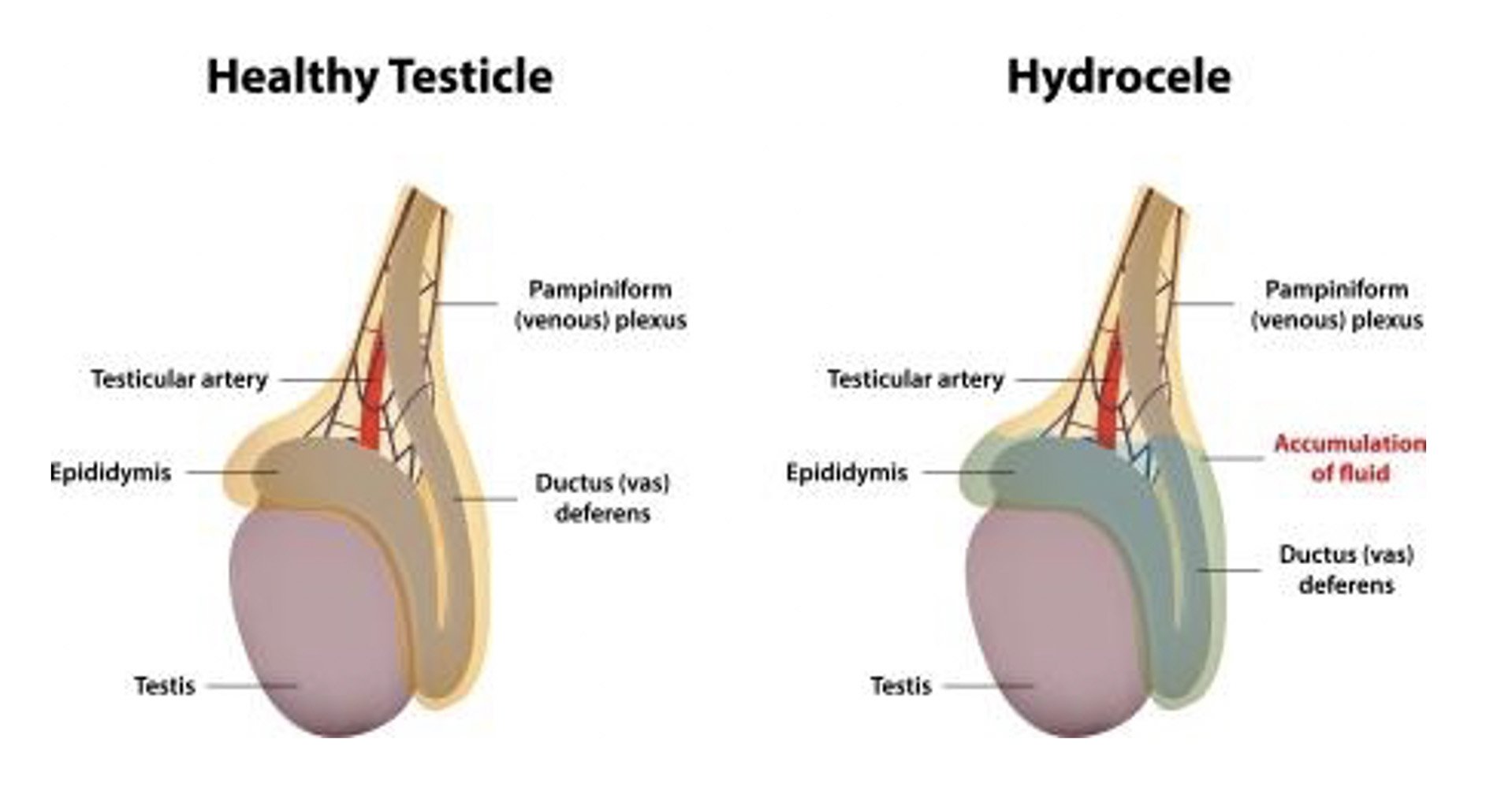 at straffe overvældende uendelig Hydrocele / Epididymal Cyst Repair — Urology Care Toowoomba | Dr Nikhil  Sapre Urologist