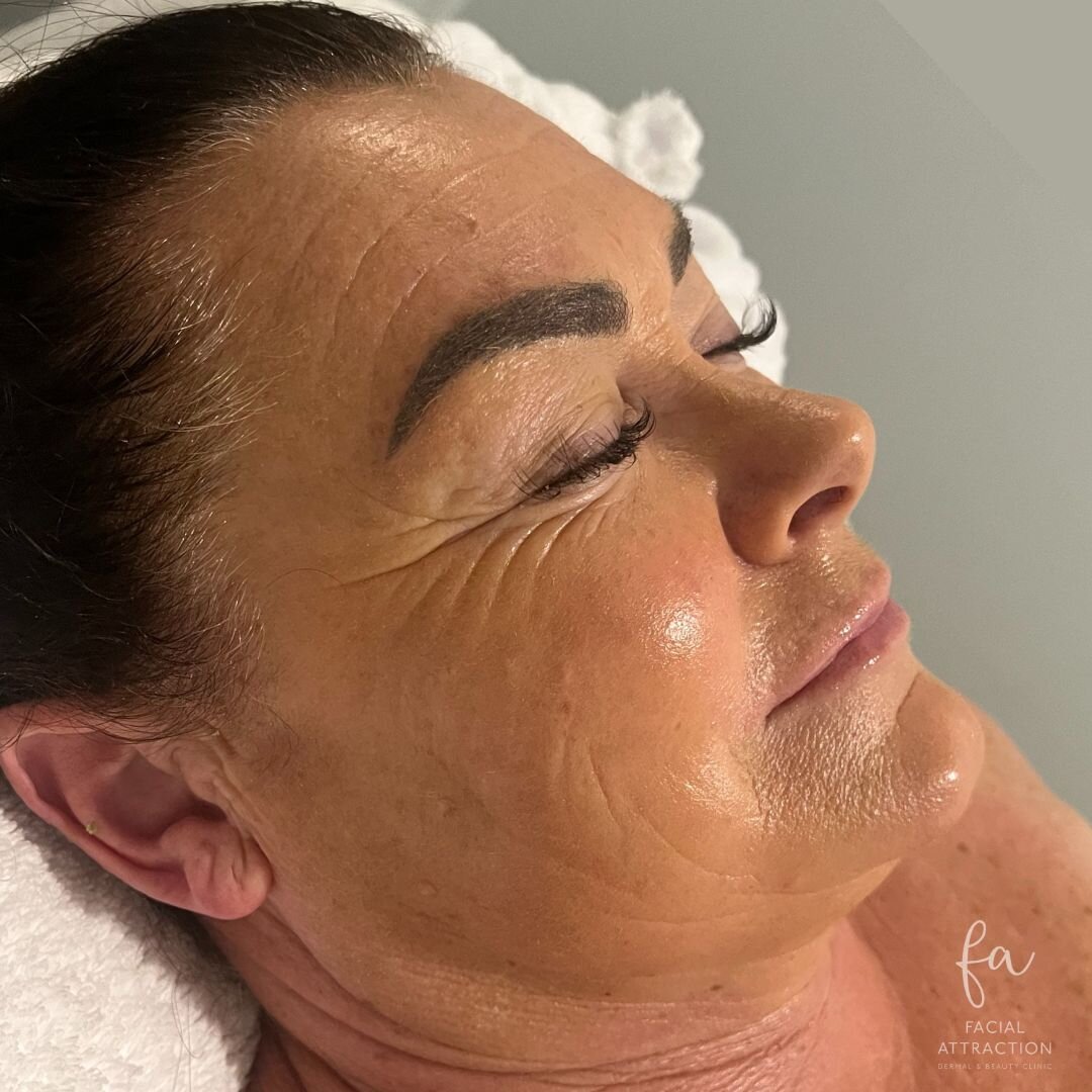That post Geneo GLOW🌟 

Deemed the &ldquo;facial of the future&rdquo; we work with multiple technologies and the highest of quality active ingredients to accelerate cell renewal, rejuvenate and oxygenate your skin. The amazing thing about the Oxygen