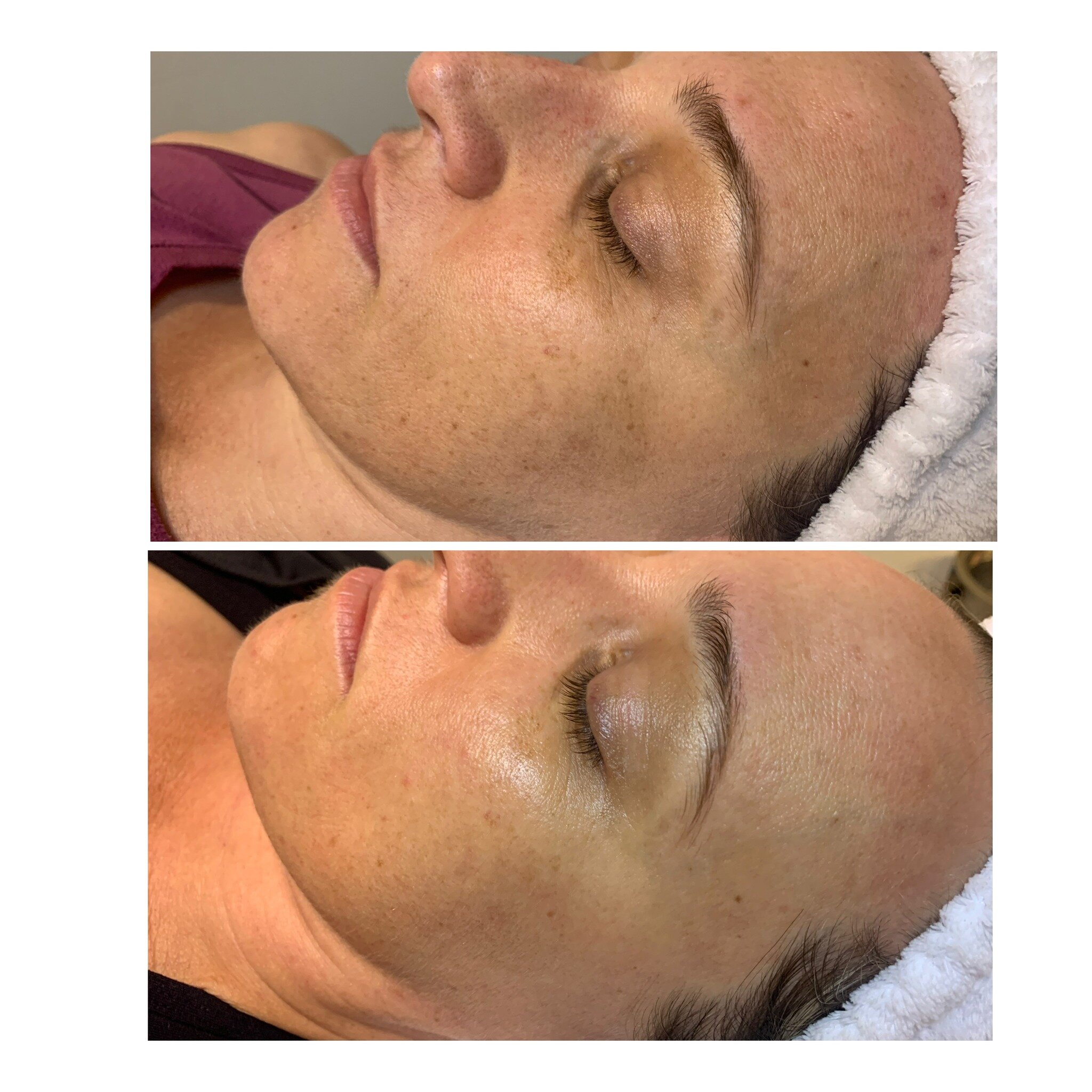 INCREDIBLE results from just 1x Illumi Facial and twice weekly Dermalux LED sessions as well as an IMAGE Skincare at home routine. 🌟

Notice the faded pigmentation on the cheek and forehead as well as all over skin rejuvenation!

IMAGE Skincare at h