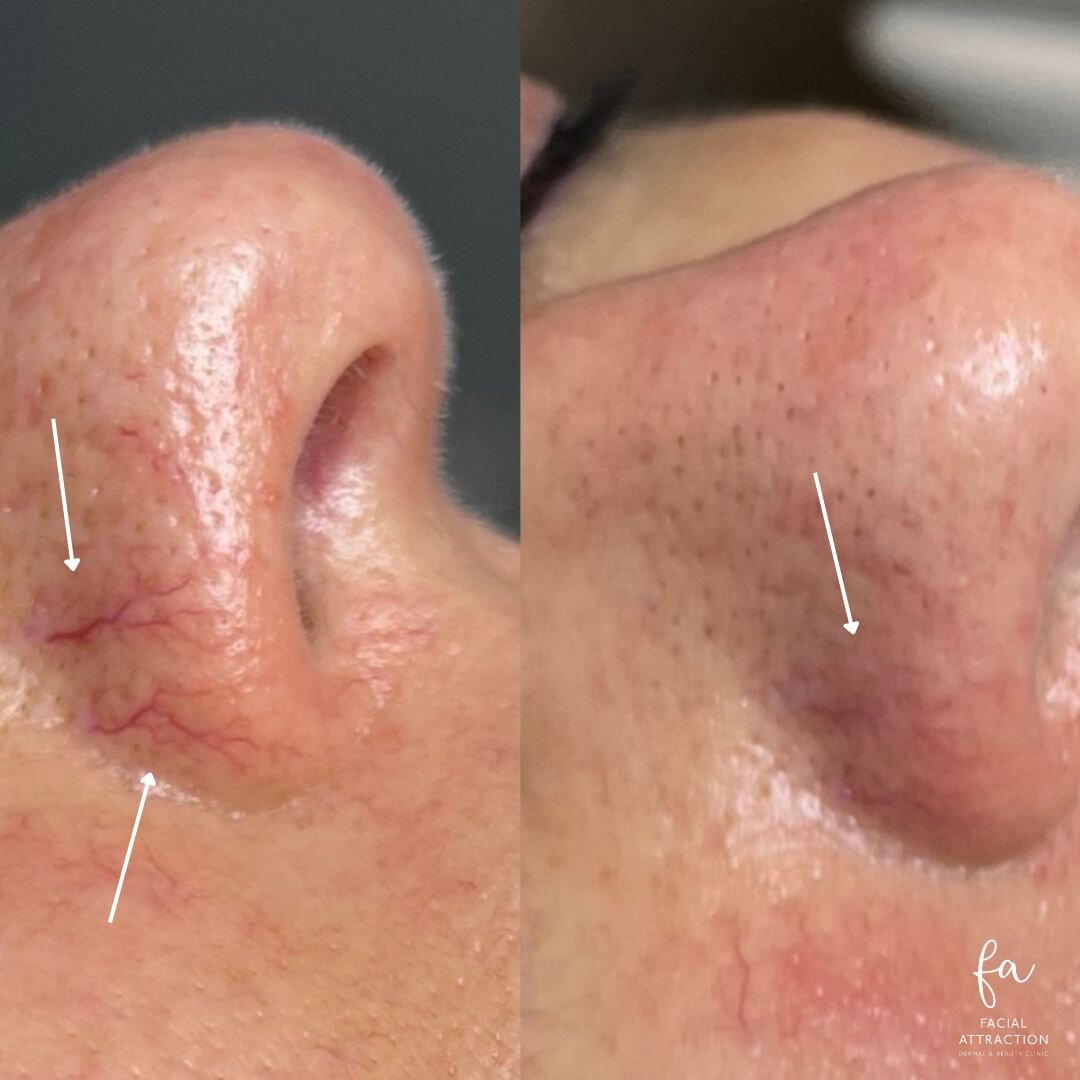 Did you know we can treat your broken blood vessels with IPL? Check out this amazing INSTANT result. 

Georgia was able to achieve this for her client after just 1 IPL session!

Just like magic 😍✨

If you want to ZAP away your skin concerns slide in