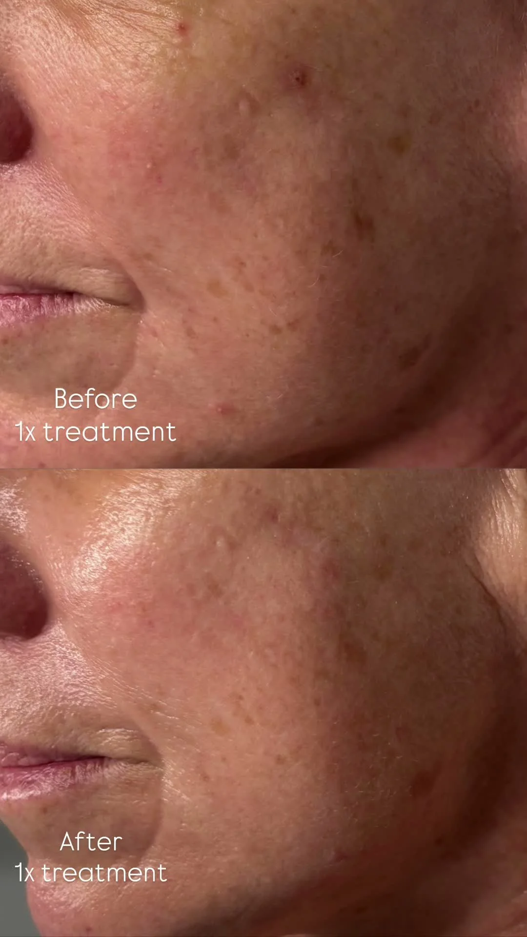The results speak for themselves ✨

Take a look at the difference in these before &amp; afters 👀

Our Tight &amp; Bright Facial, powered by Alpha IPL by Formatek, is one of our go-to treatments for transforming sun-damaged, uneven and redness-prone 