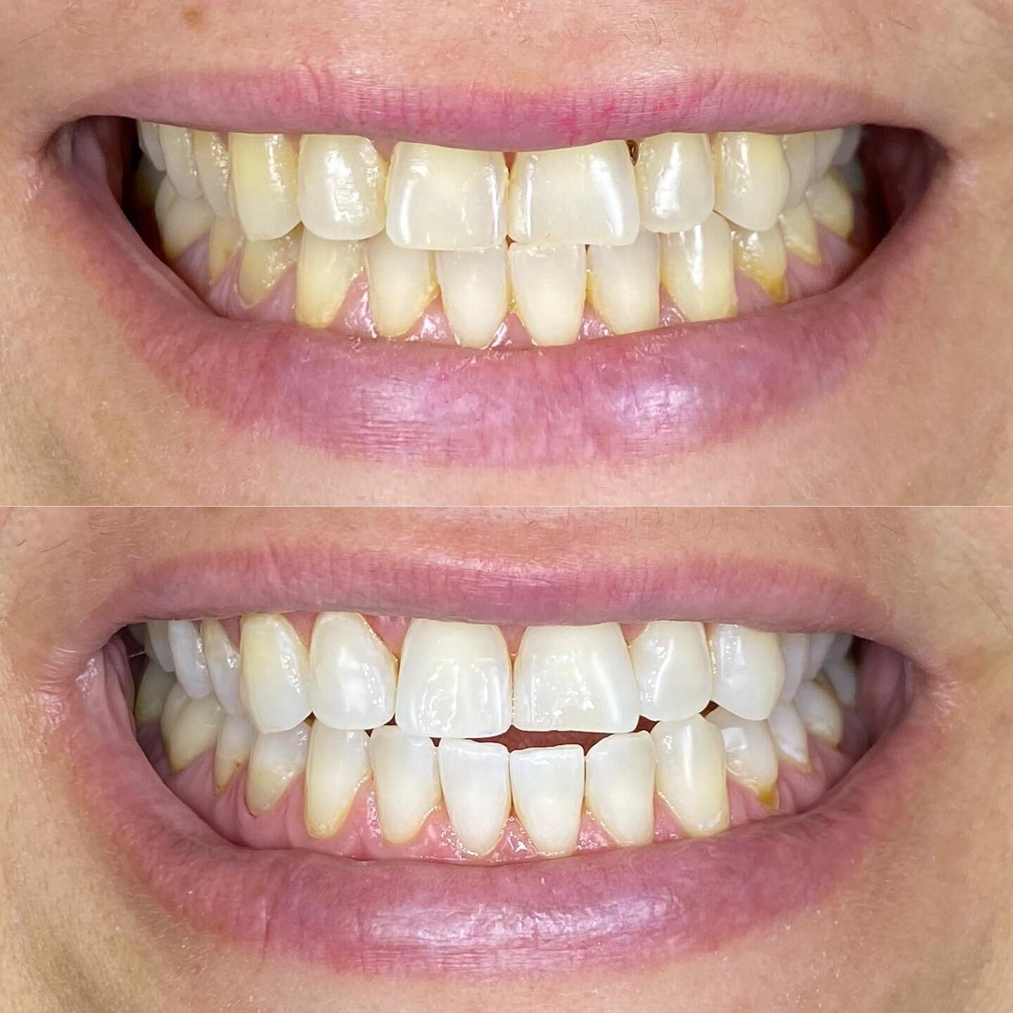 Who loves another great Zoom in-chair teeth whitening result? #wedo 😆 
Hope you do too! @hunters_hill_lifestyle 

If you&rsquo;d like your teeth to look whiter, come and see us at Maison Dental Hunters Hill.
Book online www.maisondental.com.au 
Or C