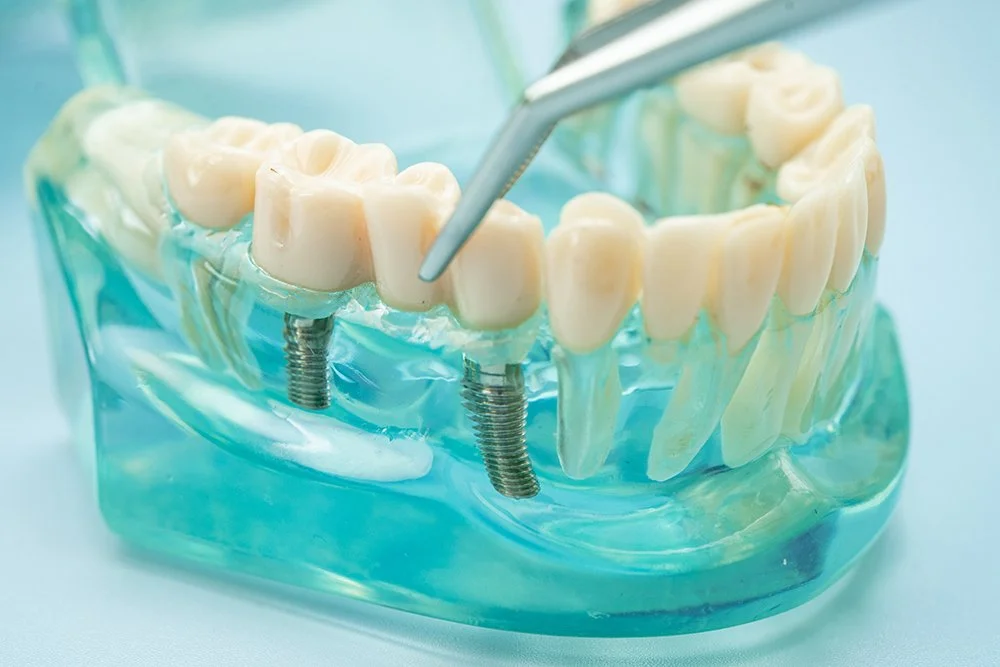 Kronen en bruggen | Tandarts Nijkerk