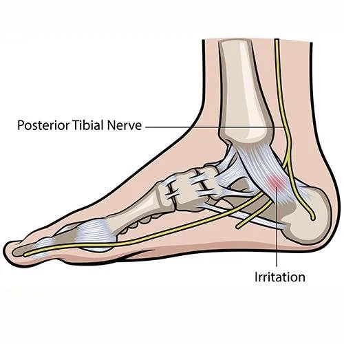 Chiropractic Treatment of Tarsal Tunnel Syndrome — ChiroUp