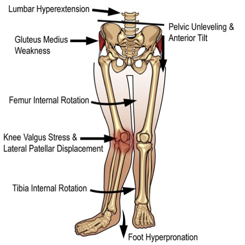 Managing Patellofemoral Pain Syndrome: New Research Insights and