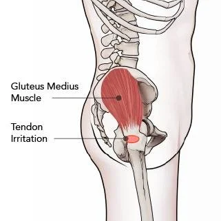 What Is The Most Common Cause Of Hip Pain ChiroUp