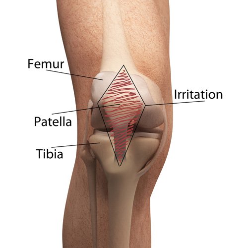 Sciences of Sport  Valgus knee: how effective are elastic mini-bands?