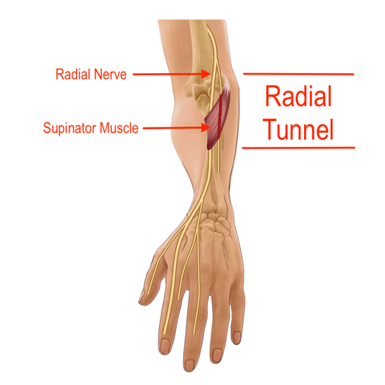 Radial Tunnel Syndrome — ChiroUp