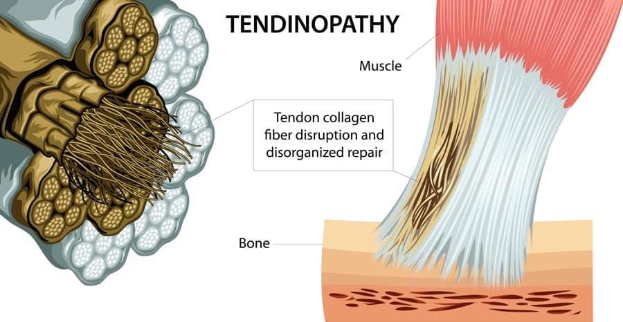 Patellar Tendinitis and Tendon Pain: Maximizing Recovery – Chief Nutrition