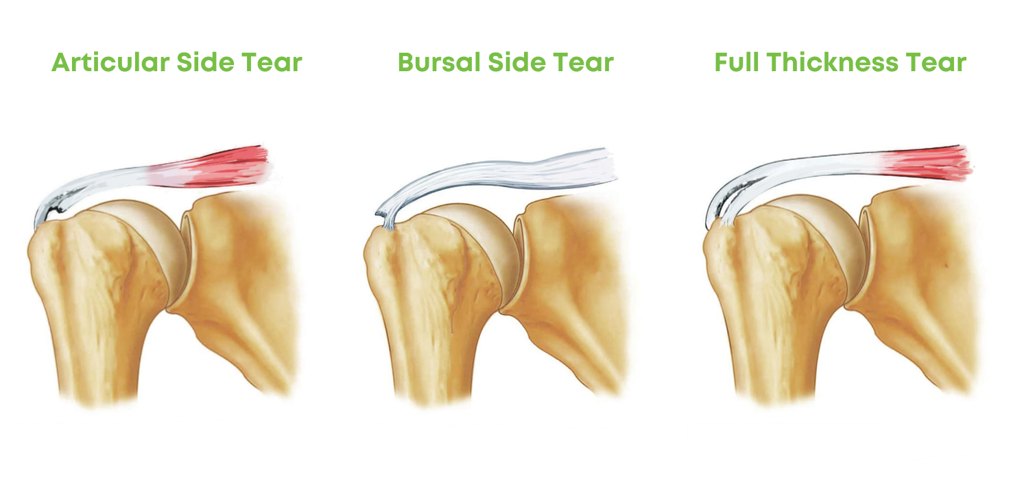 Full-Thickness vs. Partial-Thickness Tear of the Rotator Cuff