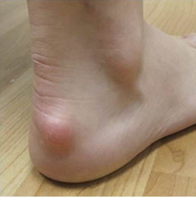 Haglund's Deformity - Dr. Hausen Empire Foot Care