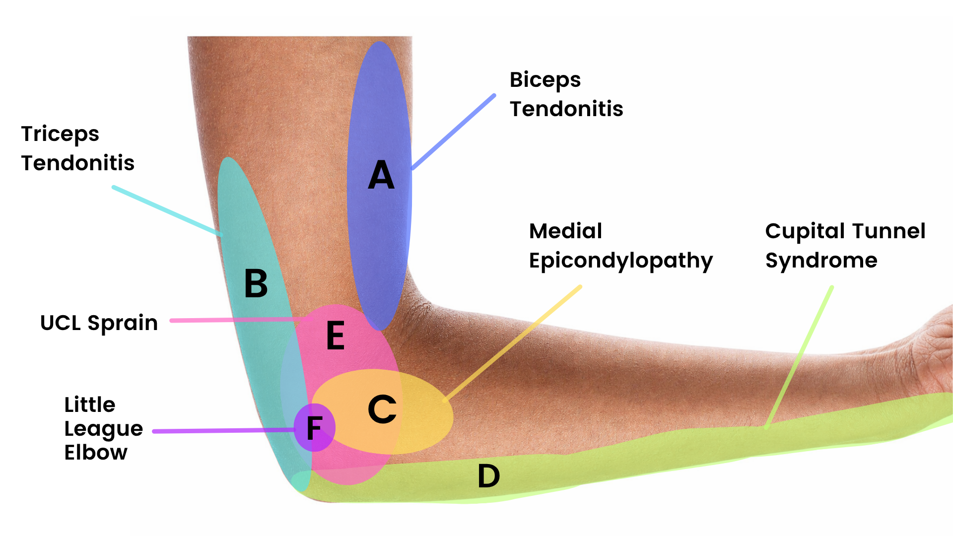 elbow-pain-location-chart
