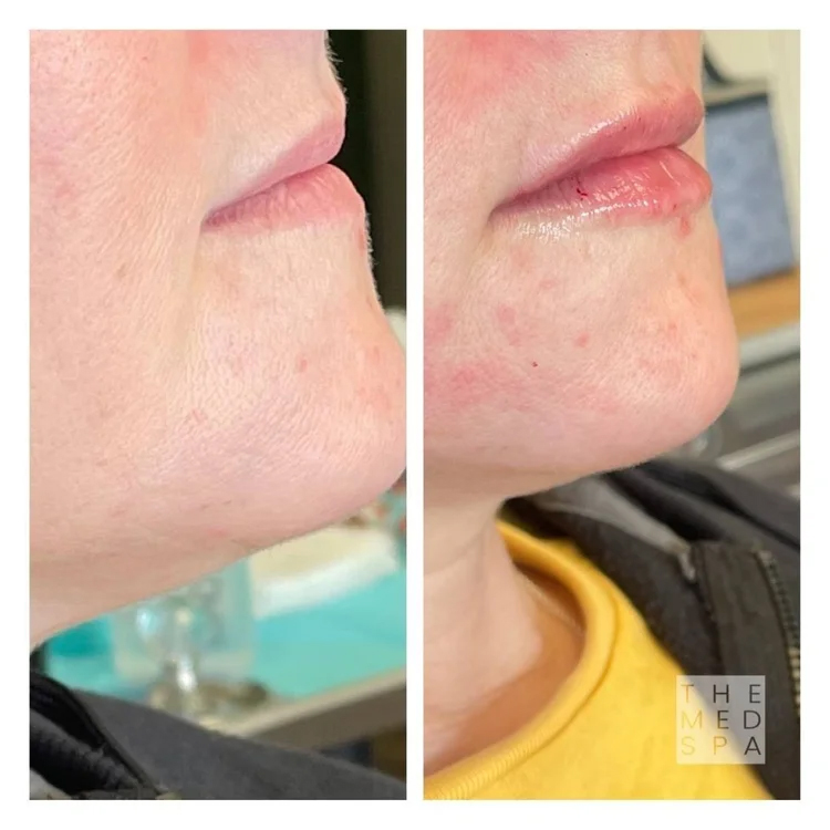 ollie Laney is one of the best lip filler injectors in Woodbury, MN. View her lip filler before and after gallery here.