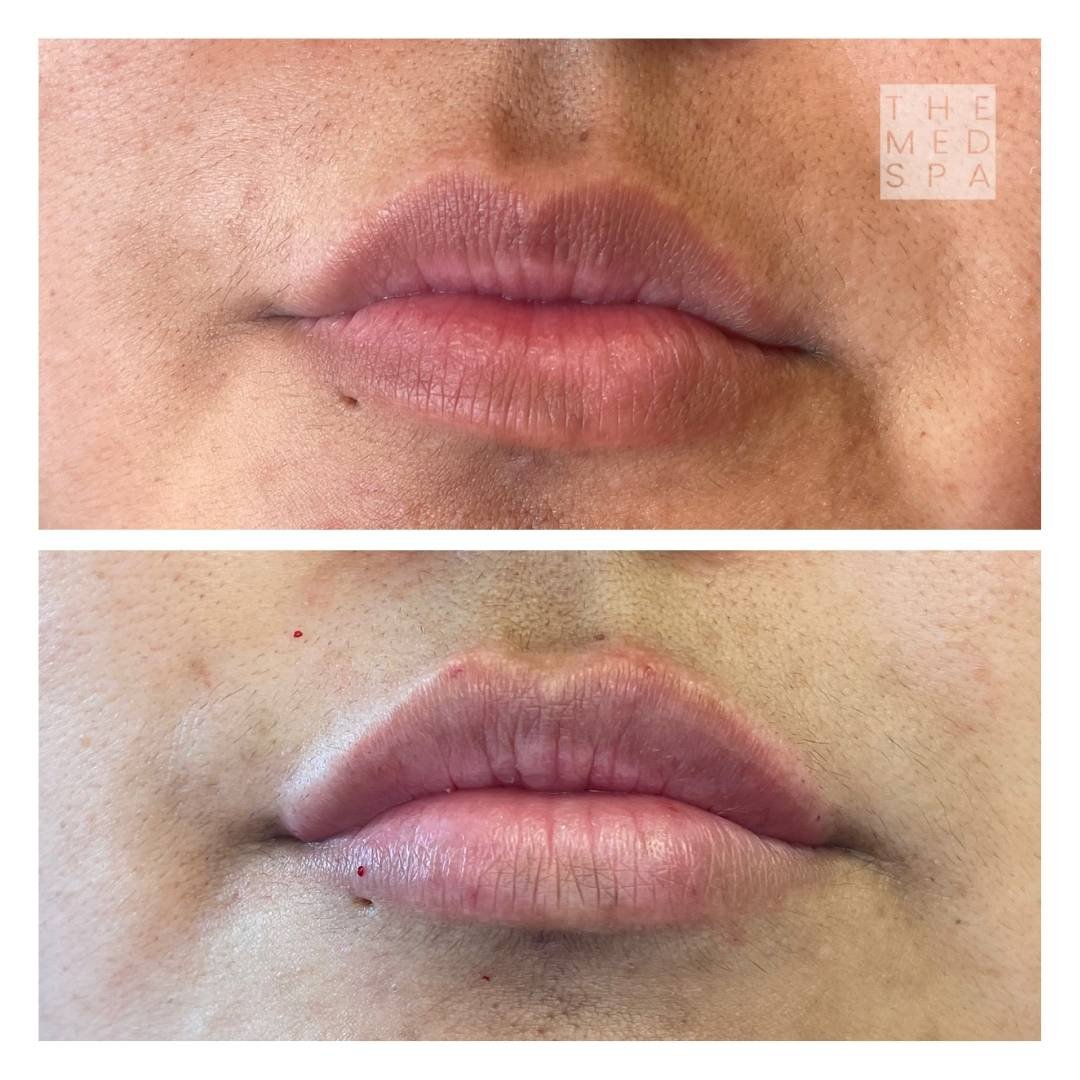 Lip fillers before and afters near me Woodbury, MN. The top lip injector in Woodbury.