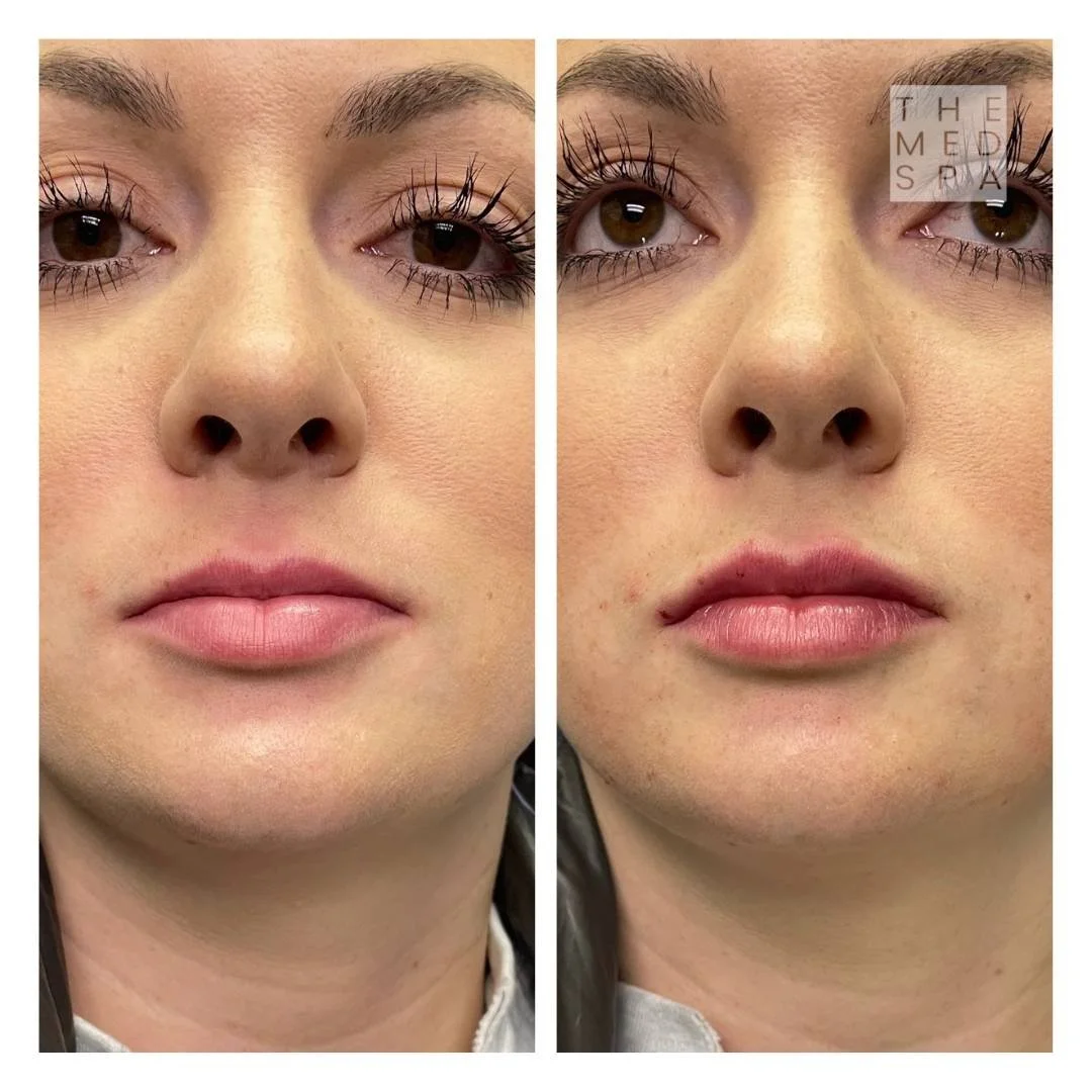 Lip fillers to correct asymmetry before and afters in Woodbury, MN. Hollie Laney named TOP 100 Aesthetic Injectors in America in 2025.