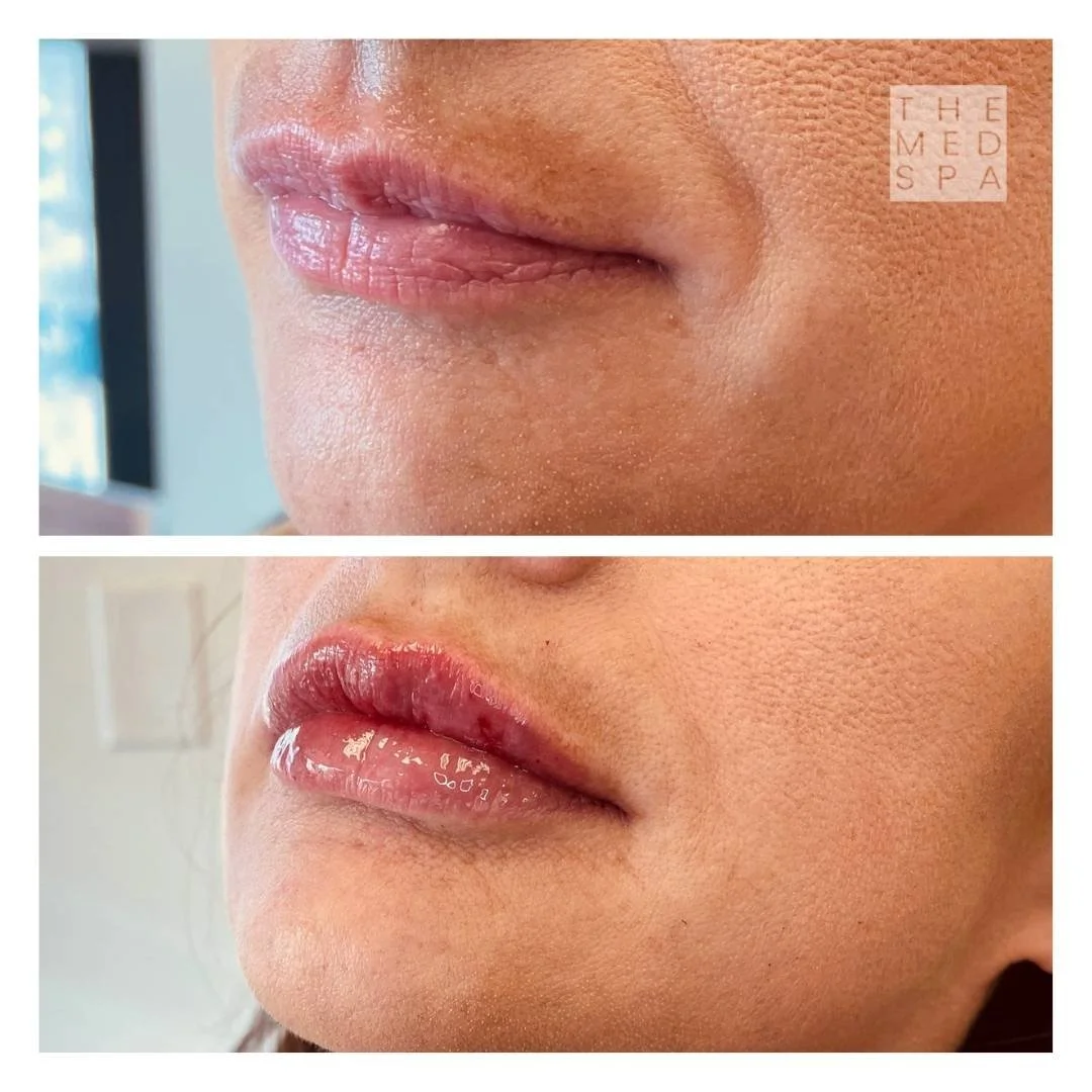 Migration lip filler correction before and afters in Woodbury, MN. Correct lip migration and address duck lips with our top Aesthetic Nurse Injectors.