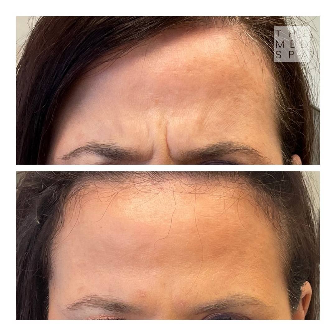 Botox to the forehead before and after patient results in Woodbury, MN.