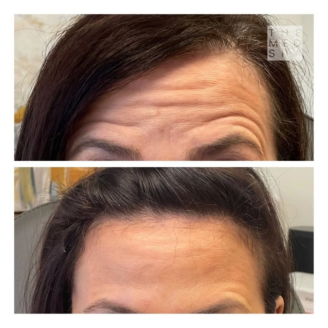 Botox Before and Afters in Woodbury, MN. Aesthetics meets wellness with The Med Spa!