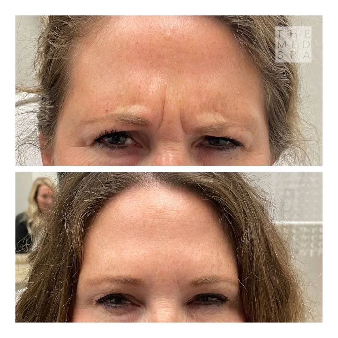 Botox for the elevens lines Before and Afters in Woodbury, MN.