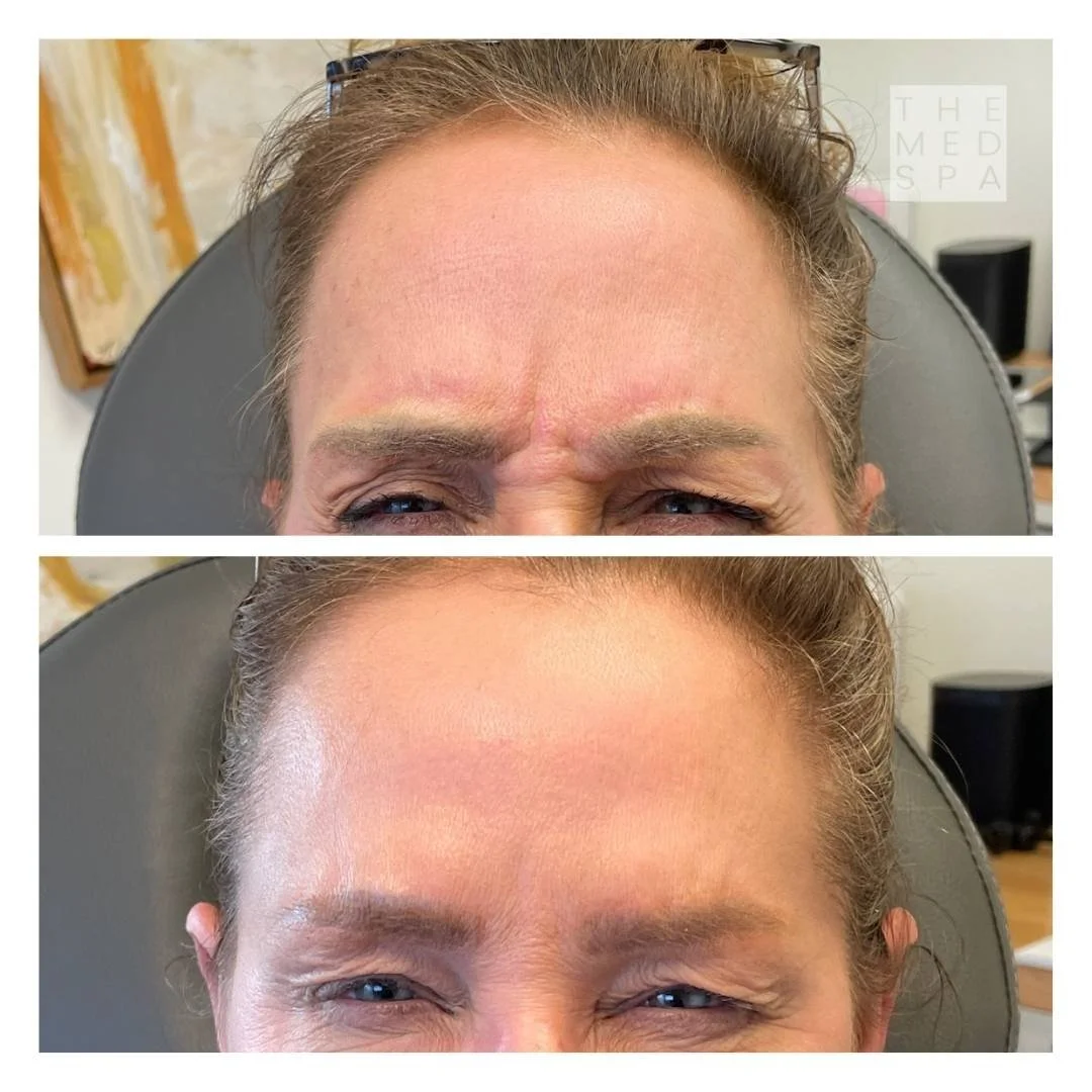 Botox eyebrow frown lines Before and Afters in Woodbury, MN. Treat frown lines with Botox.