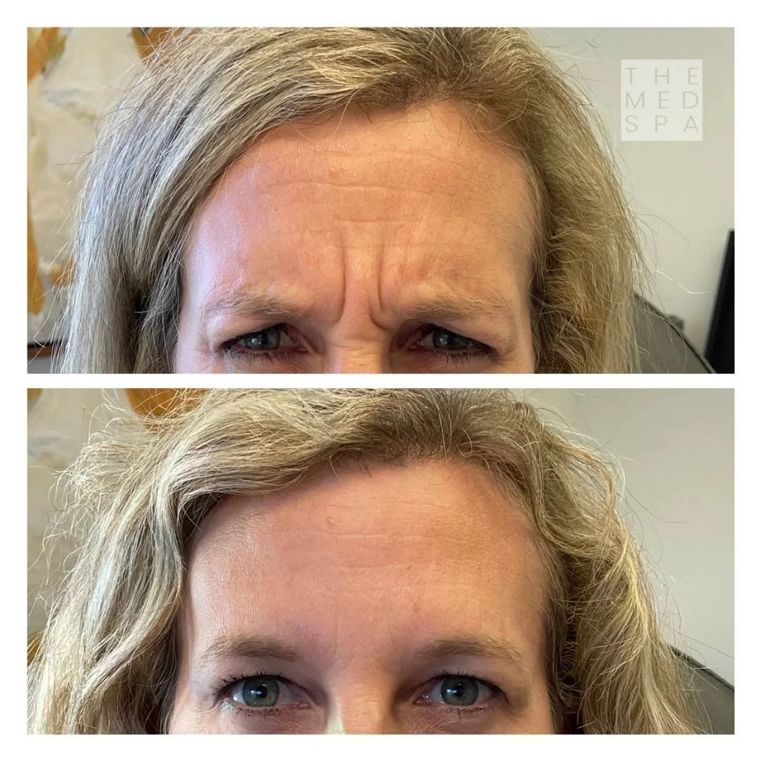 Worry Lines treatment with Botox. Patient results in Woodbury, MN.