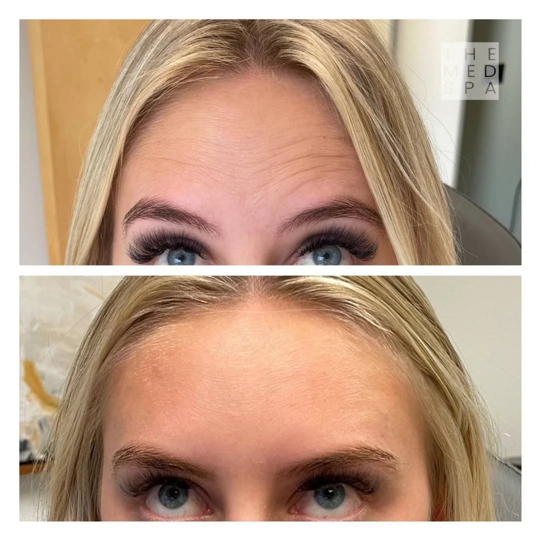 Botox forehead wrinkles Before and Afters in Woodbury, MN. Address forehead wrinkles with Botox.