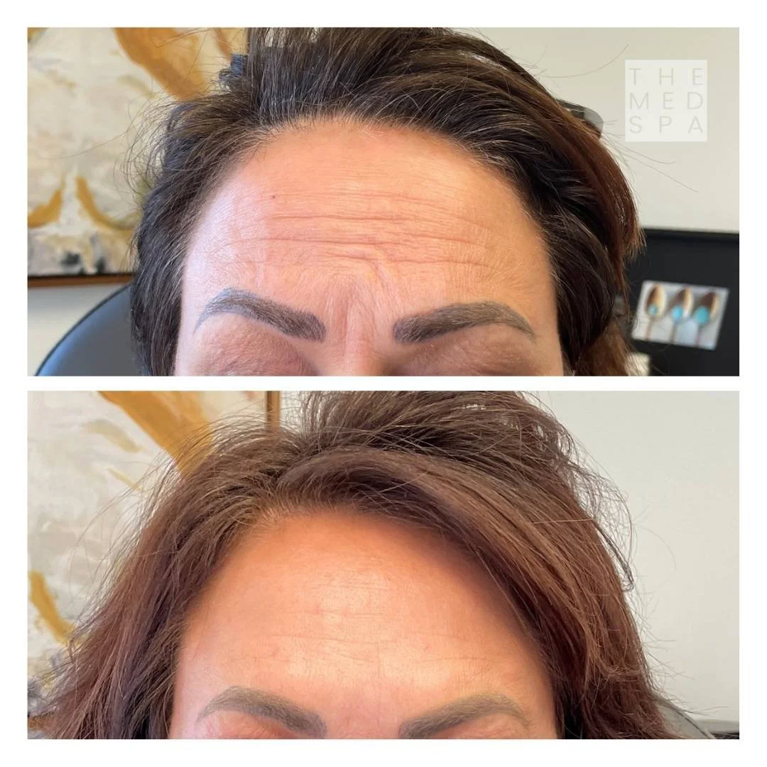 Botox for forehead wrinkles before and after patient results in Woodbury, MN.