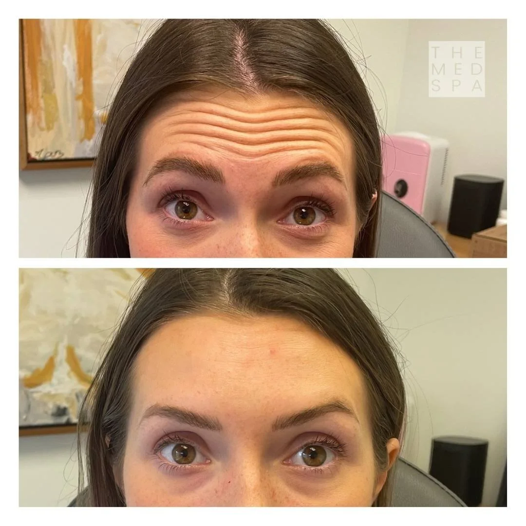 Patient results for Botox to the forehead from the Top Botox injectors in Woodbury, MN.