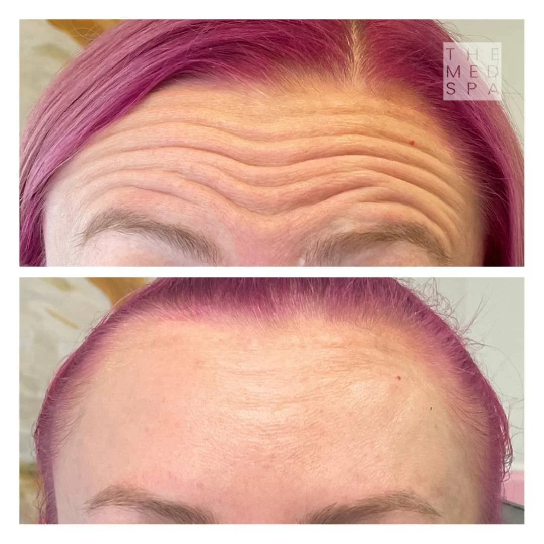 Botox before and afters for women at the top Med Spa in Woodbury, MN.