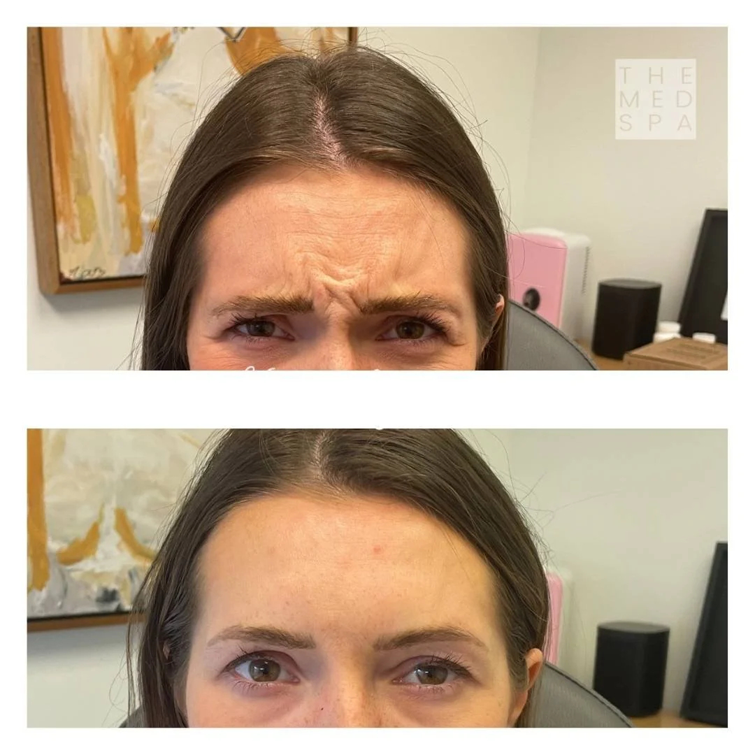 View these patient results for Botox forehead treatment in Woodbury, MN from The Med Spa.