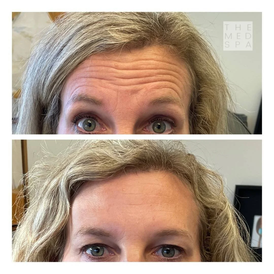 View amazing patient results after Botox injections at The Med Spa in Woodbury, MN.