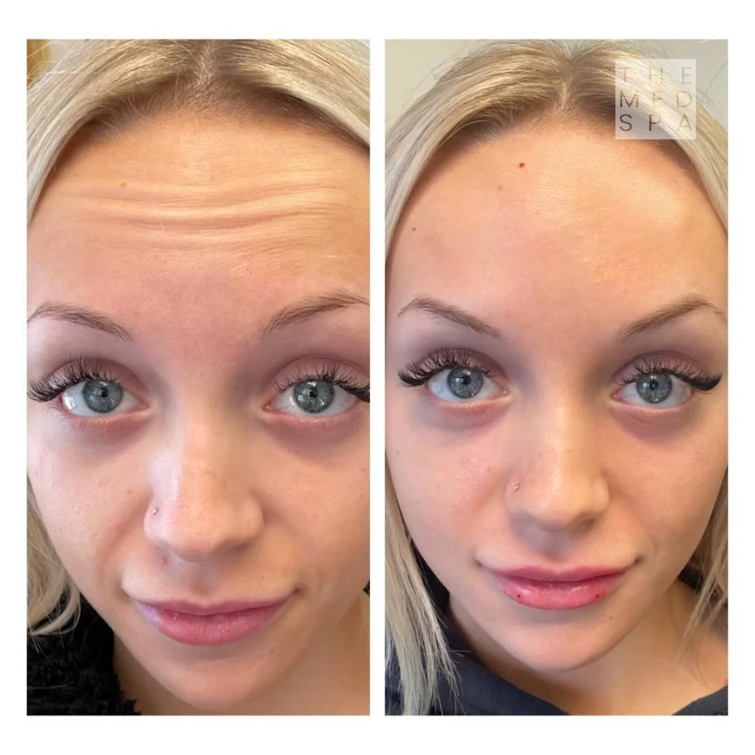 #1 Med Spa Botox before and afters in Woodbury, MN.