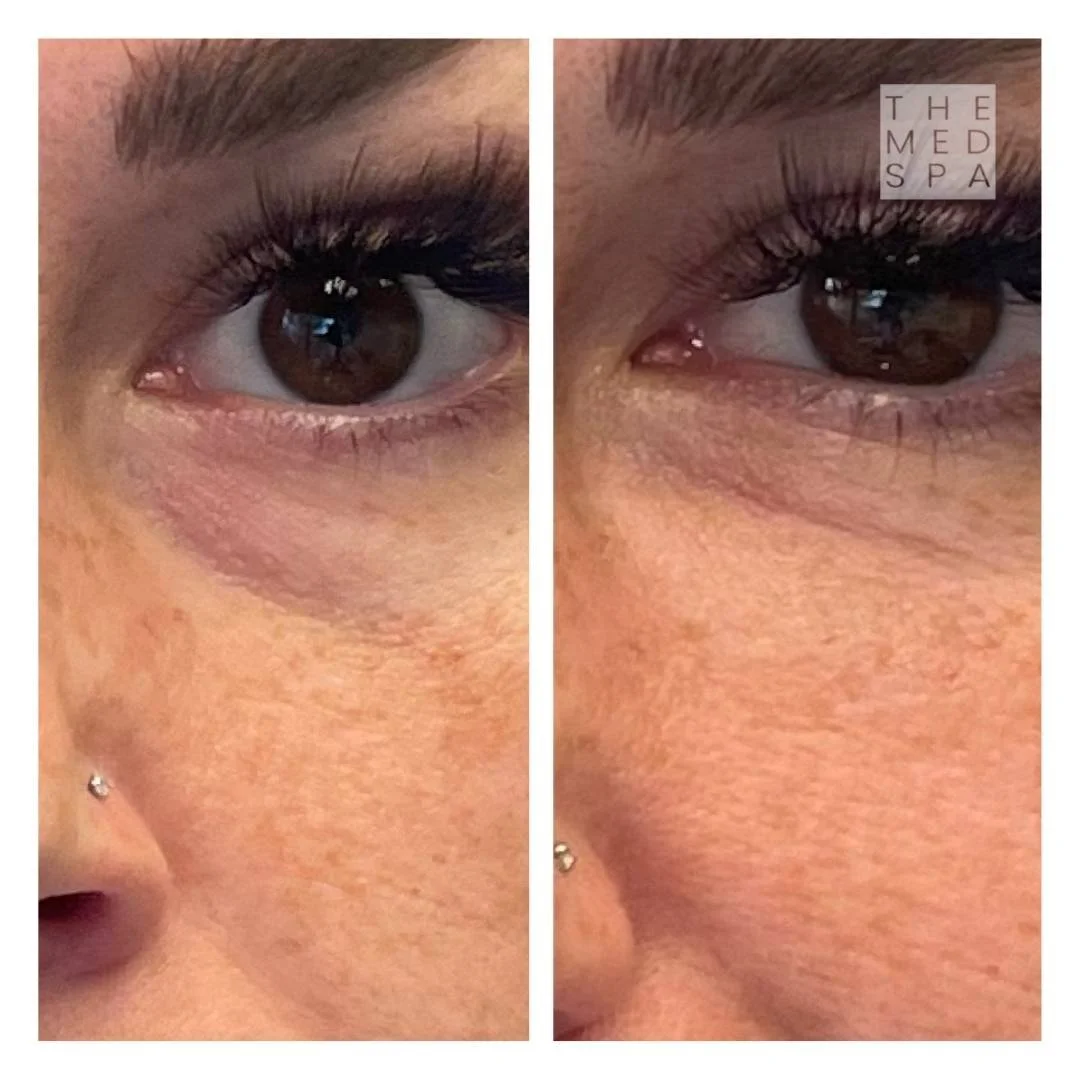 PRF injectable under eyes to tear troughs before and after results in Woodbury, MN.